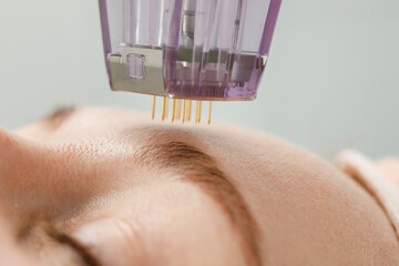 Is Microneedling Effective For Acne Scars?